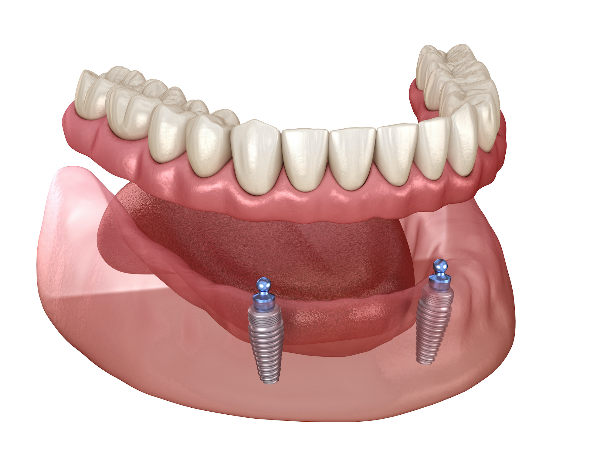 Point Loma Implant Retained Dentures Lighthouse Dental